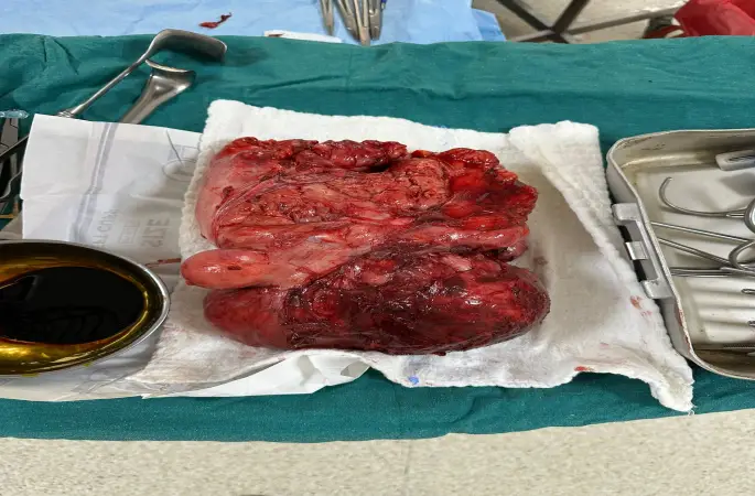 Göğüs Cerrahisinde Nadir Görülen Tümör Başarıyla Çıkarıldı