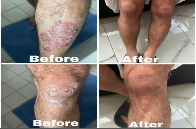 Balıklı Kaplıca’ya Büyük Darbe: Sağlık Ruhsatı İptal Edildi